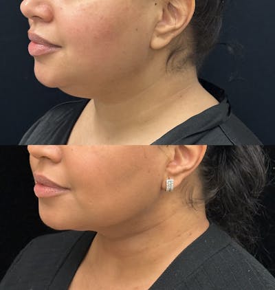 Buccal Fat Reduction Before & After Gallery - Patient 129726 - Image 3