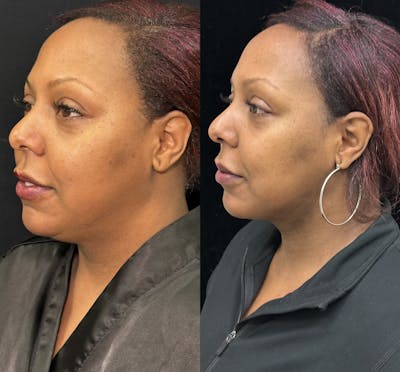 Chin & Neck Lipo Sculpting Before & After Gallery - Patient 378228 - Image 3