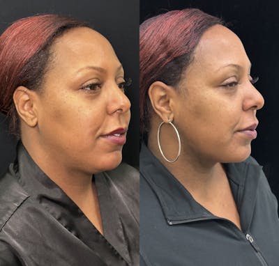 Chin & Neck Lipo Sculpting Before & After Gallery - Patient 378228 - Image 2