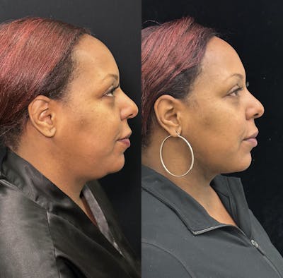 Chin & Neck Lipo Sculpting Before & After Gallery - Patient 378228 - Image 1