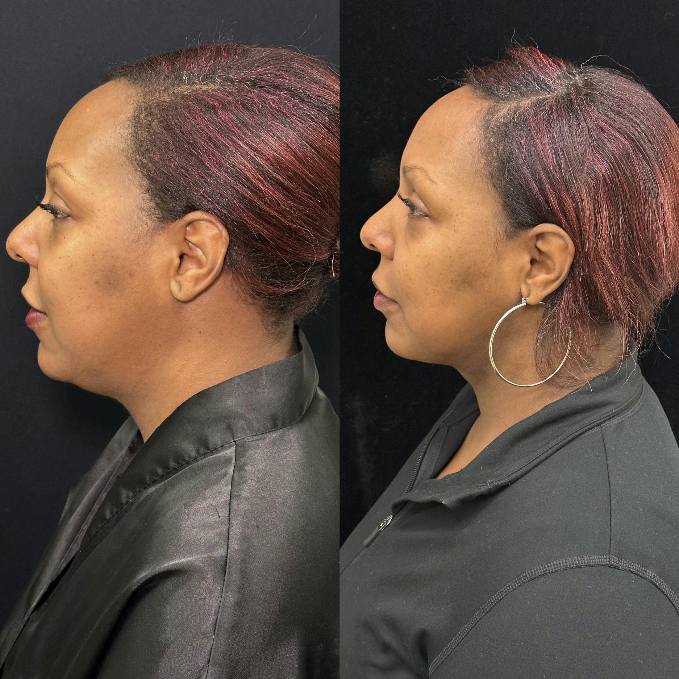 Chin & Neck Lipo Sculpting Before & After Gallery - Patient 378228 - Image 4