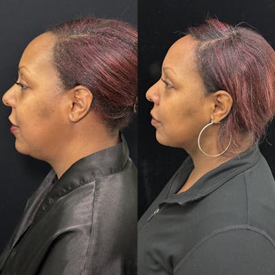 Chin & Neck Lipo Sculpting Before & After Gallery - Patient 378228 - Image 4
