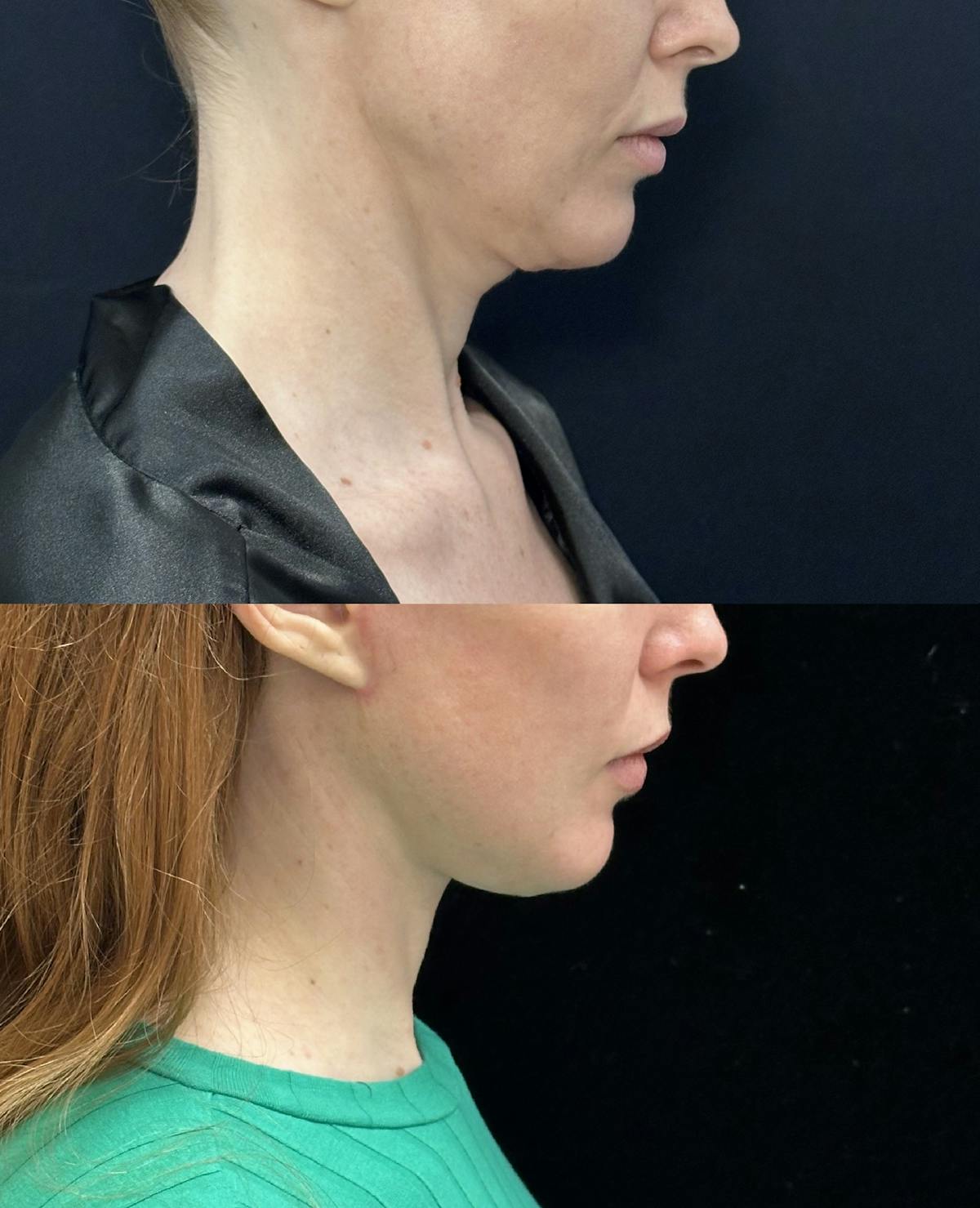 Deep Plane Facelift Before & After Gallery - Patient 361810 - Image 2