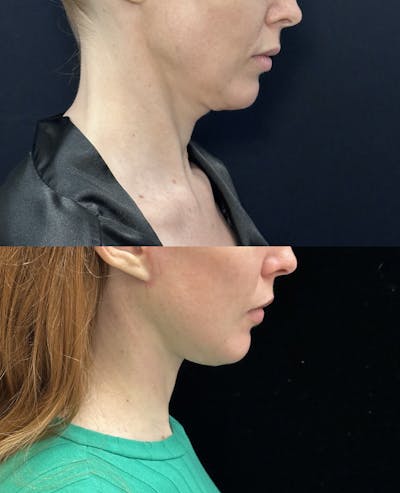 Deep Plane Facelift Before & After Gallery - Patient 361810 - Image 2