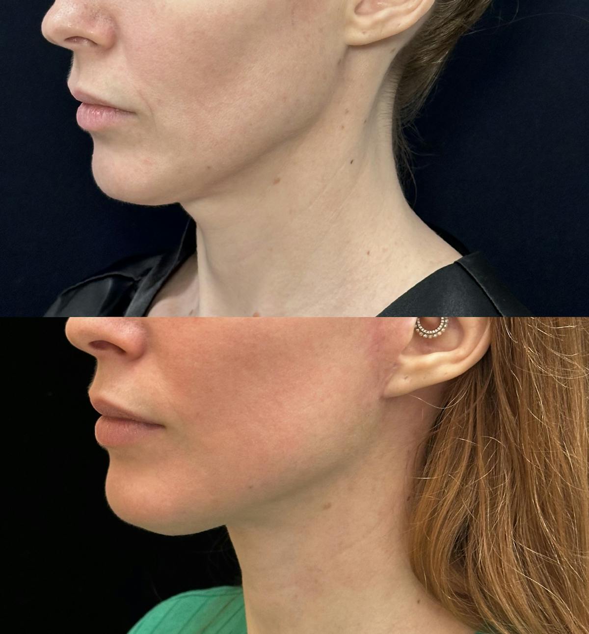 Deep Plane Facelift Before & After Gallery - Patient 361810 - Image 3
