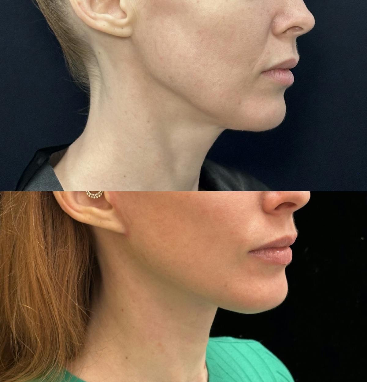 Deep Plane Facelift Before & After Gallery - Patient 361810 - Image 1