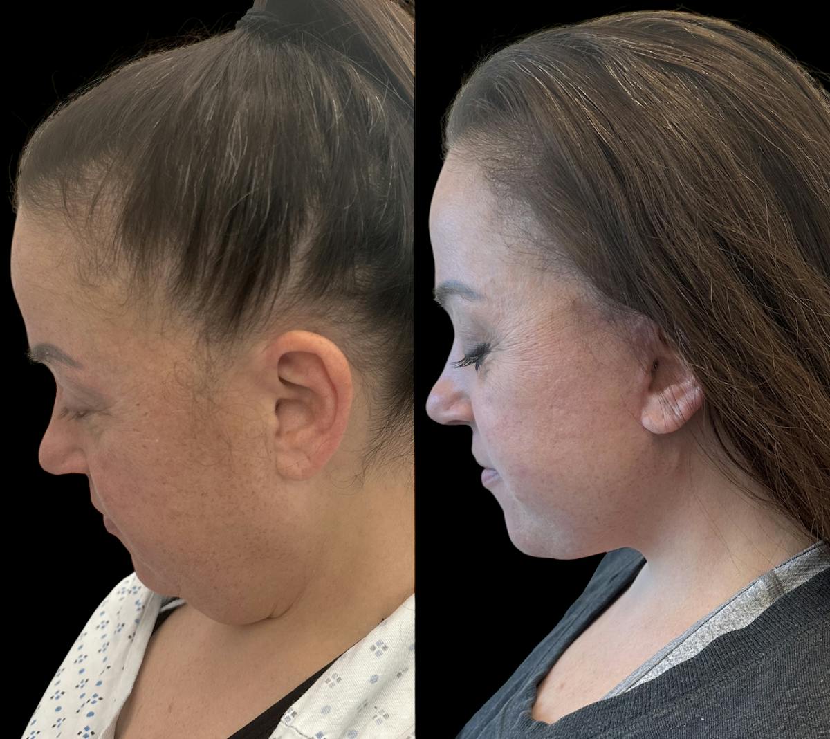 Deep Plane Facelift Before & After Gallery - Patient 389662 - Image 4