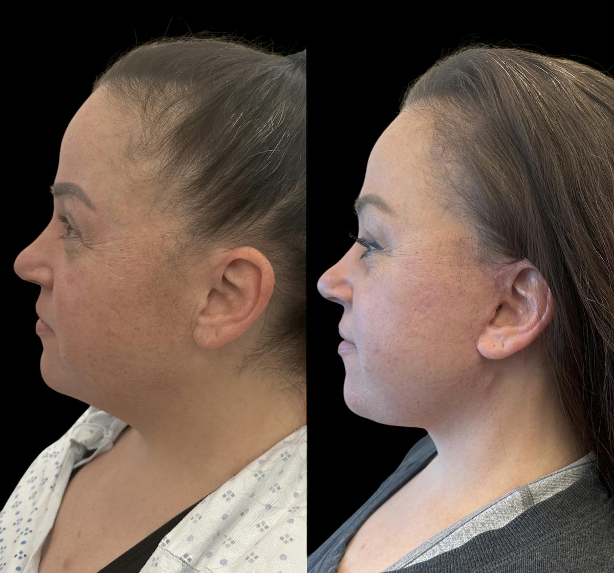 Deep Plane Facelift Before & After Gallery - Patient 389662 - Image 5