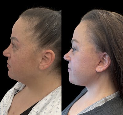 Deep Plane Facelift Before & After Gallery - Patient 389662 - Image 5