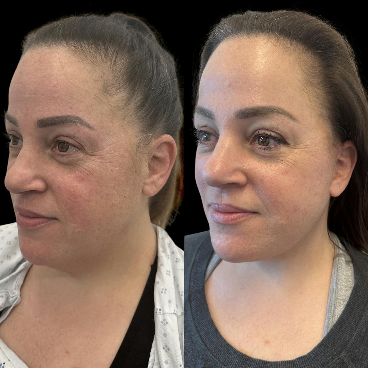 Deep Plane Facelift Before & After Gallery - Patient 389662 - Image 6