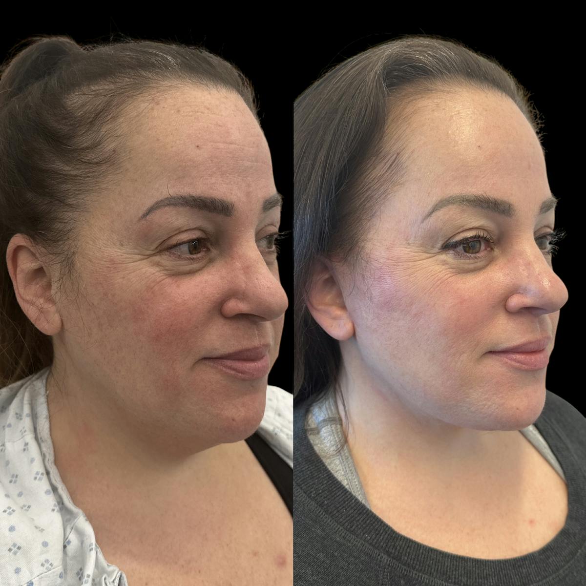 Deep Plane Facelift Before & After Gallery - Patient 389662 - Image 1