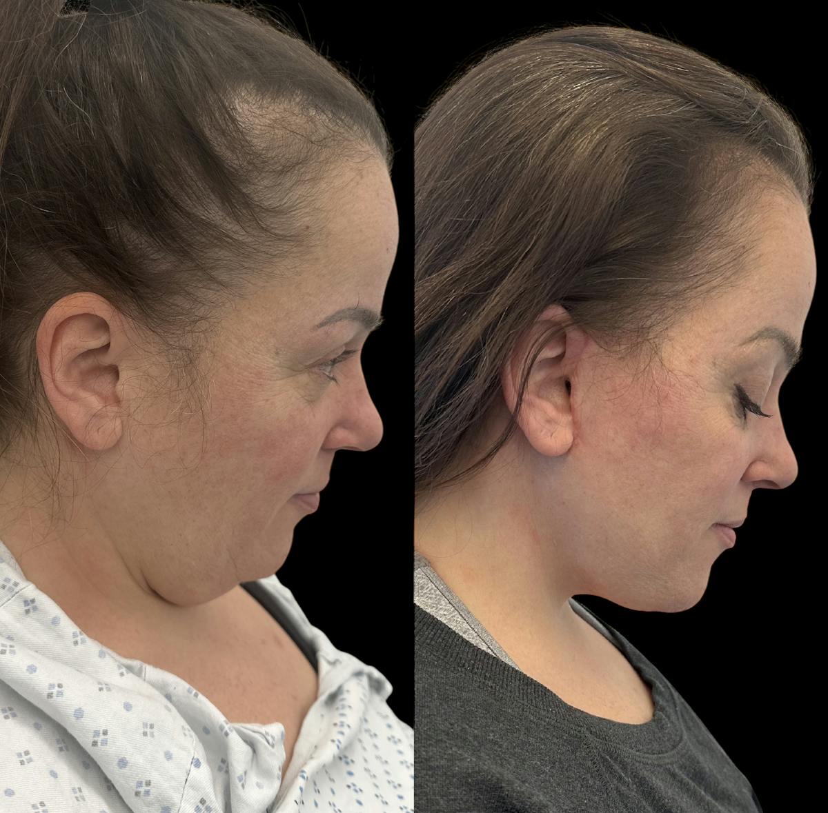 Deep Plane Facelift Before & After Gallery - Patient 389662 - Image 3