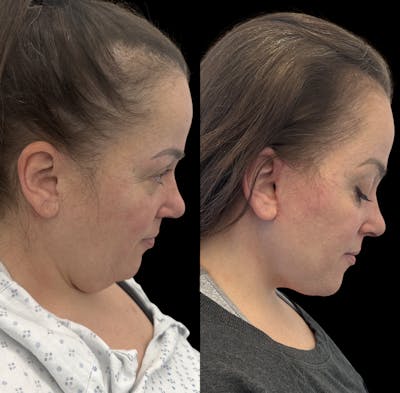 Deep Plane Facelift Before & After Gallery - Patient 389662 - Image 3