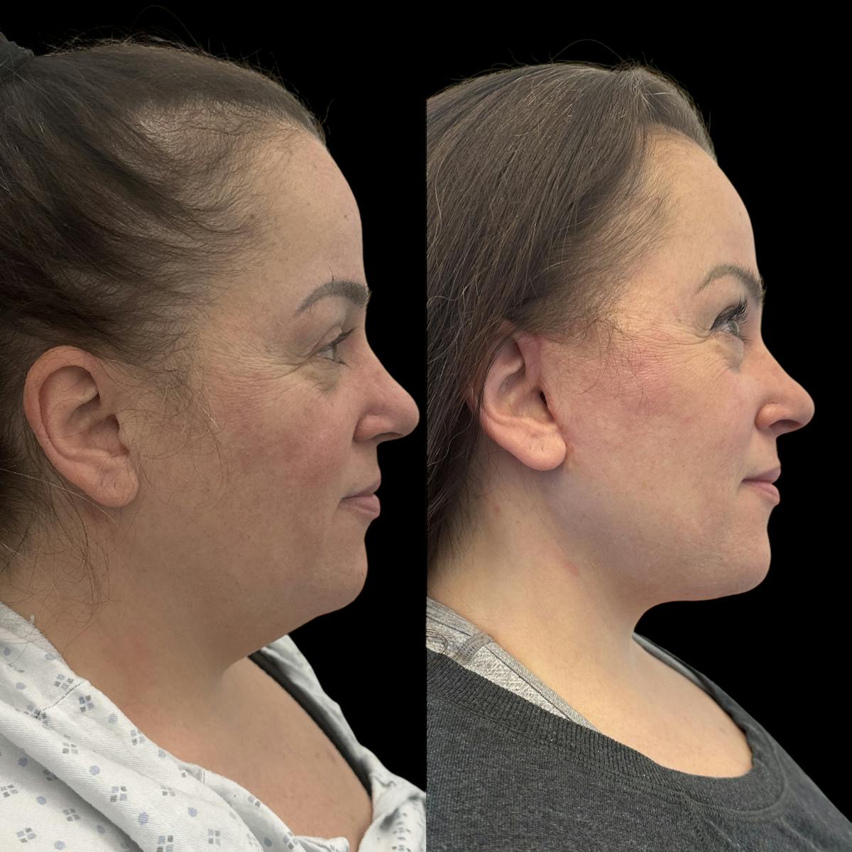 Deep Plane Facelift Before & After Gallery - Patient 389662 - Image 2