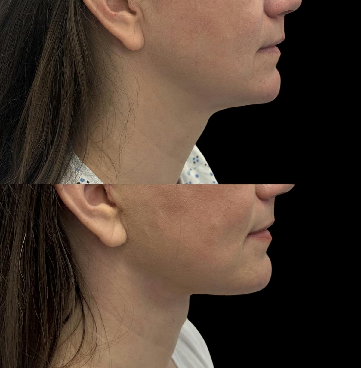 Deep Plane Facelift Before & After Gallery - Patient 280273 - Image 1
