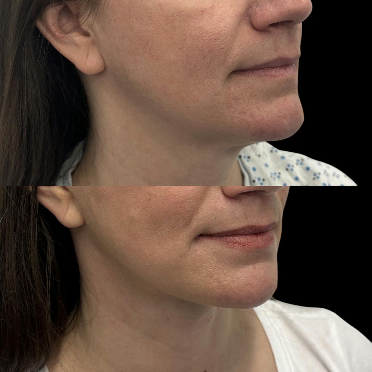 Deep Plane Facelift Before & After Gallery - Patient 280273 - Image 4