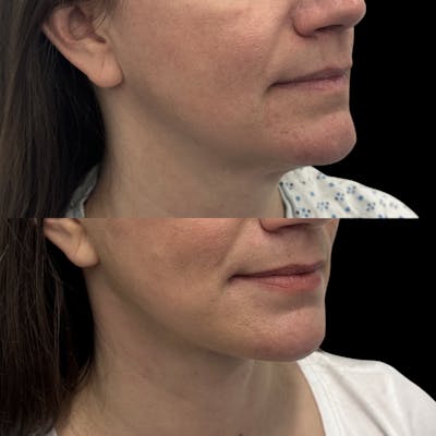 Deep Plane Facelift Before & After Gallery - Patient 280273 - Image 4