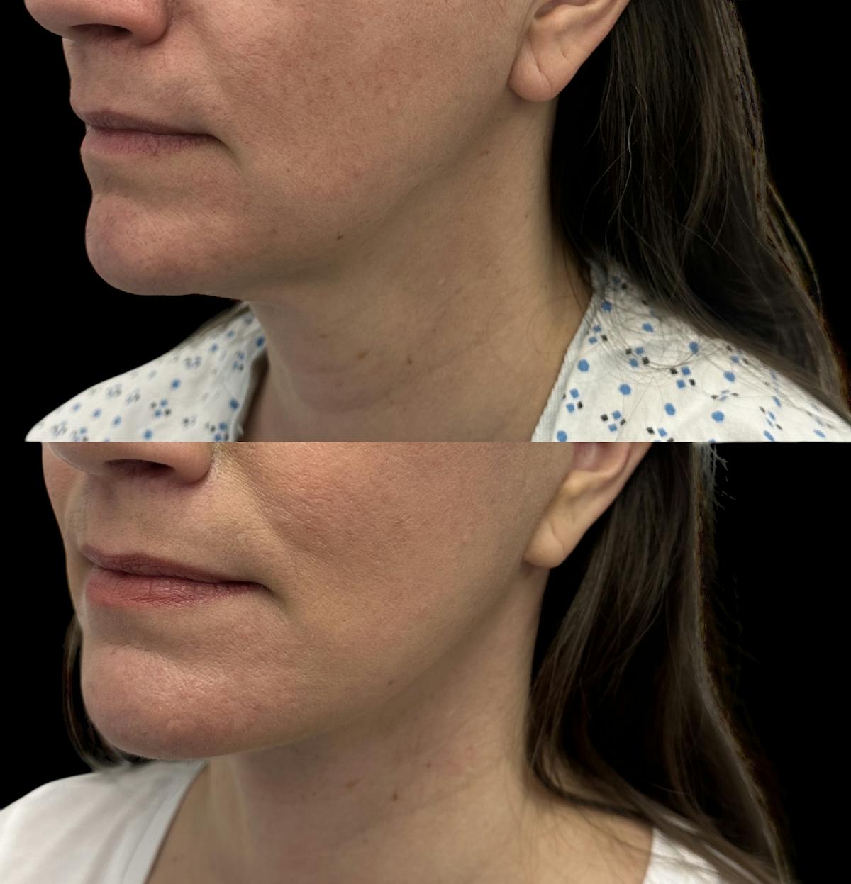 Deep Plane Facelift Before & After Gallery - Patient 280273 - Image 3