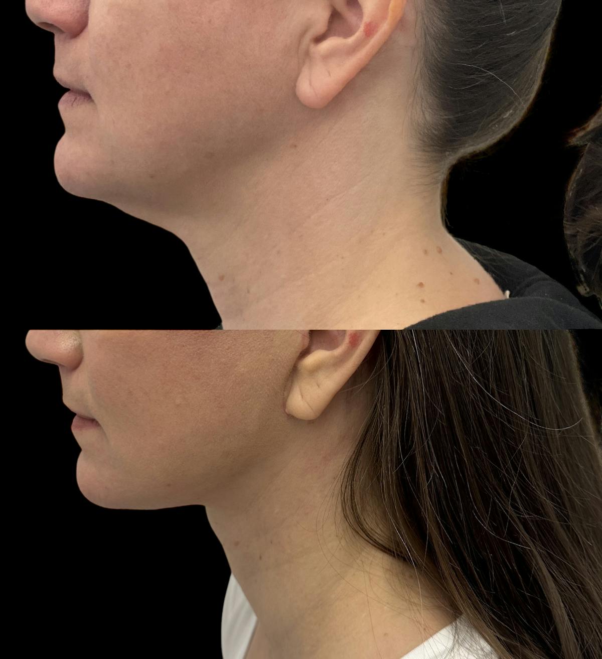 Deep Plane Facelift Before & After Gallery - Patient 280273 - Image 2