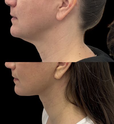 Deep Plane Facelift Before & After Gallery - Patient 280273 - Image 2