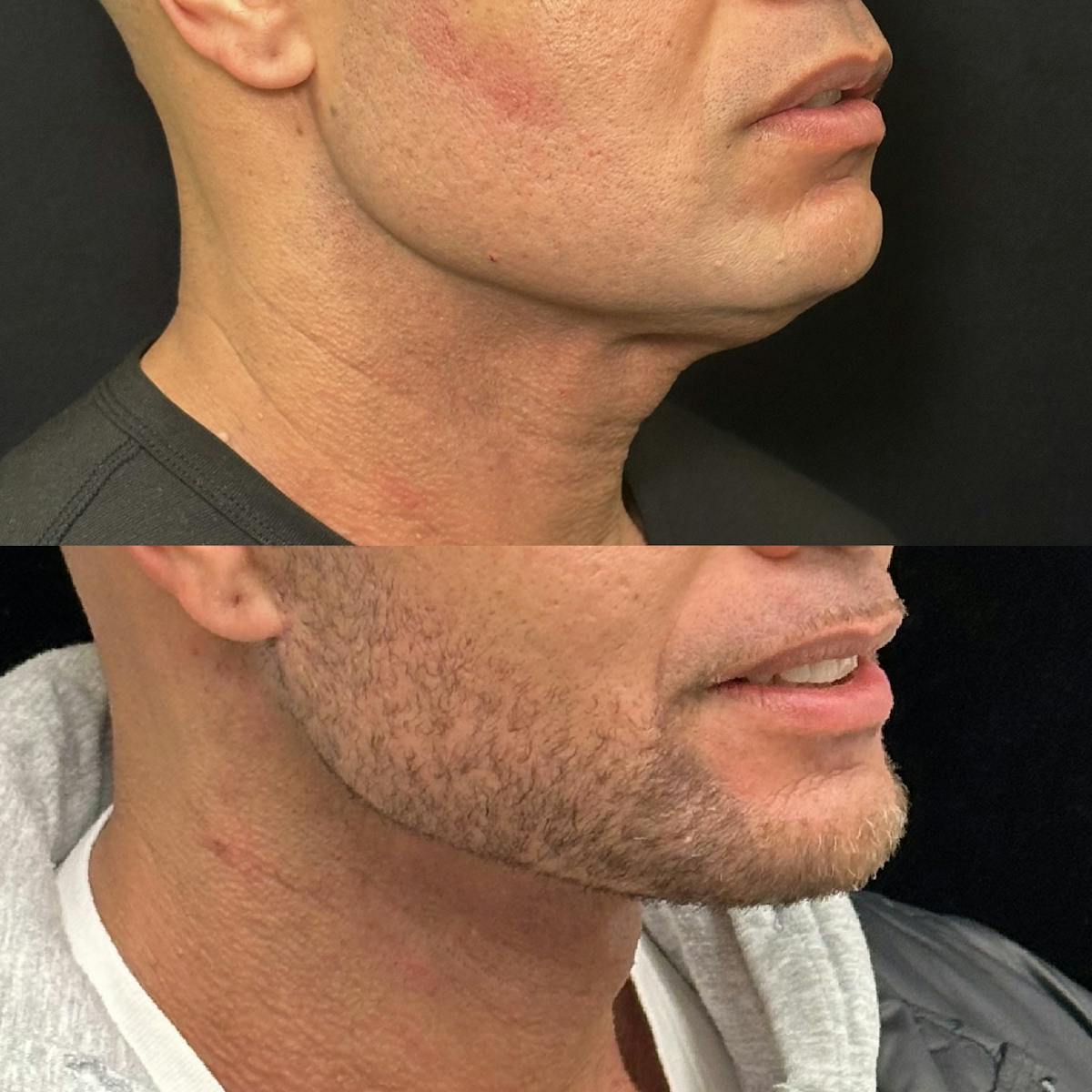 Deep Plane Facelift Before & After Gallery - Patient 997767 - Image 2