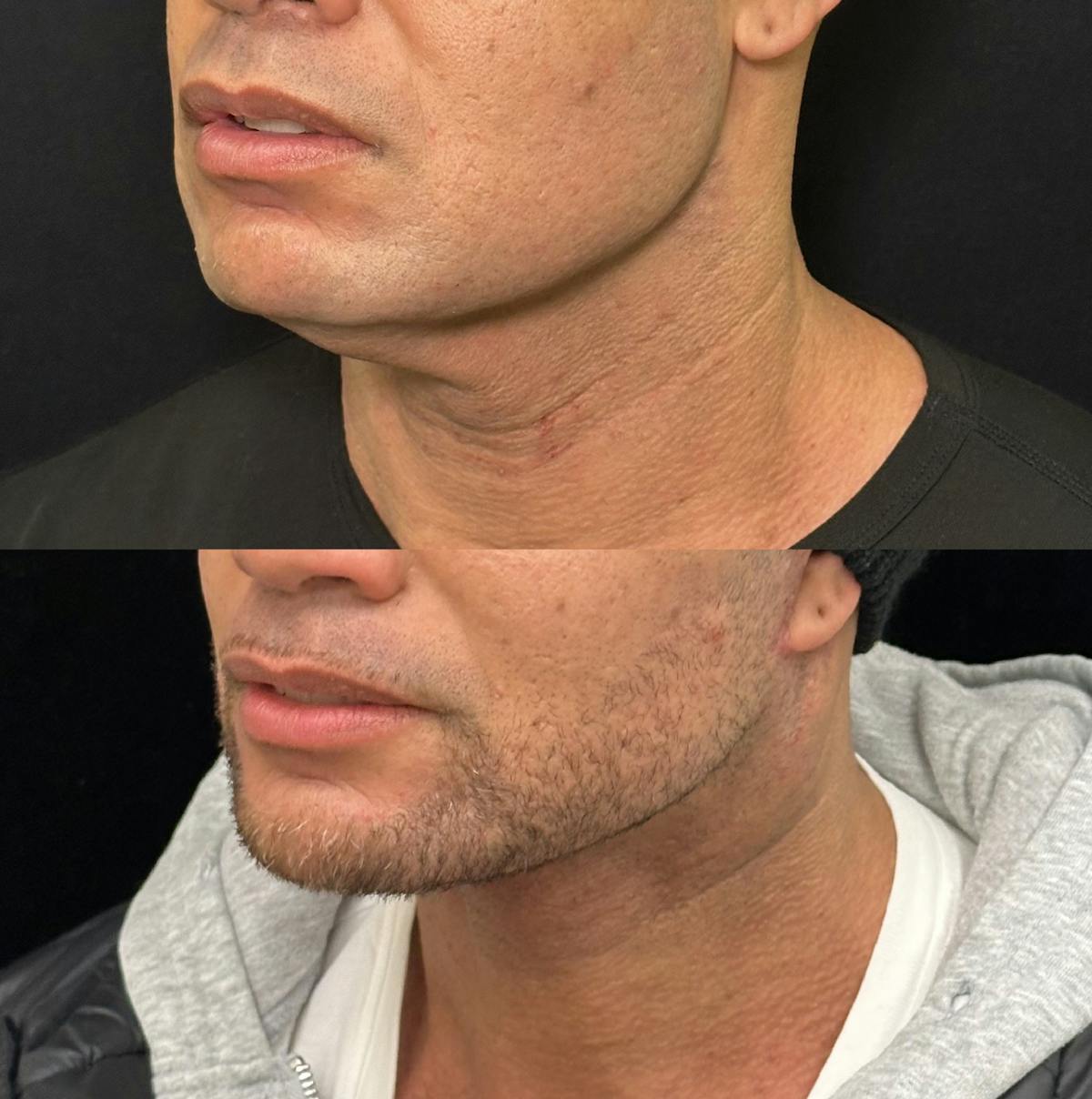 Deep Plane Facelift Before & After Gallery - Patient 997767 - Image 4
