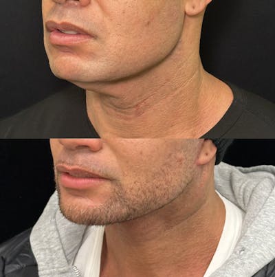 Deep Plane Facelift Before & After Gallery - Patient 997767 - Image 4