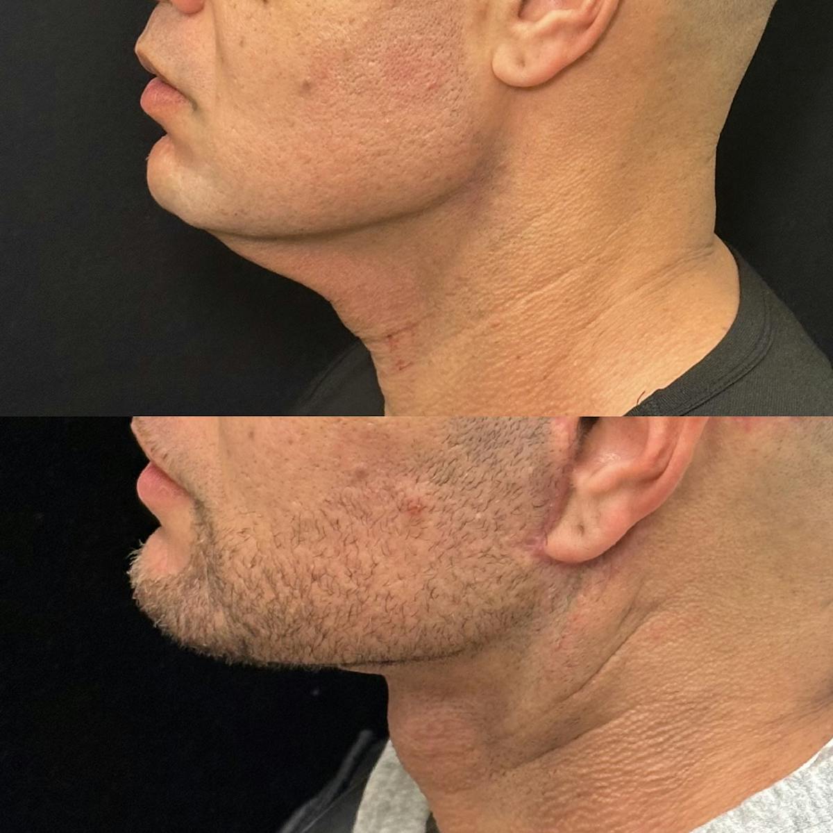 Deep Plane Facelift Before & After Gallery - Patient 997767 - Image 3
