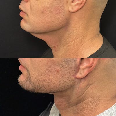 Deep Plane Facelift Before & After Gallery - Patient 997767 - Image 3