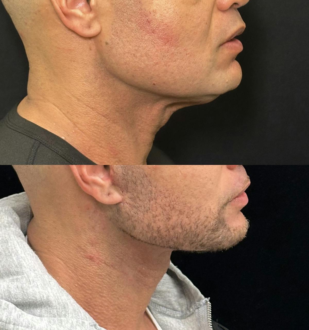 Deep Plane Facelift Before & After Gallery - Patient 997767 - Image 1