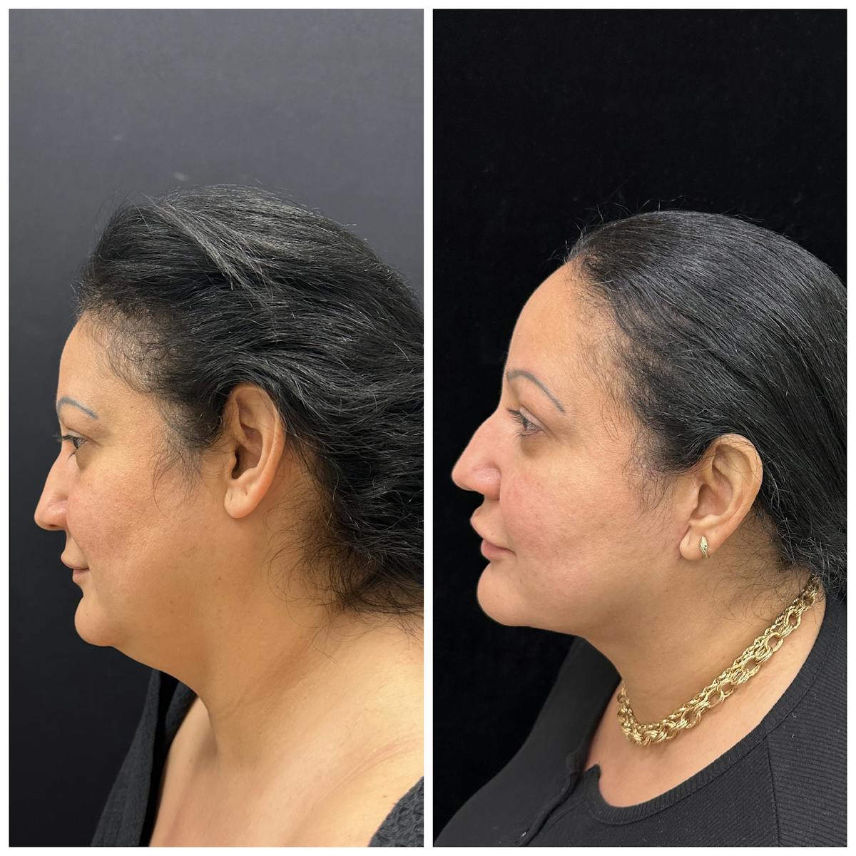 Deep Plane Facelift Before & After Gallery - Patient 101985 - Image 4