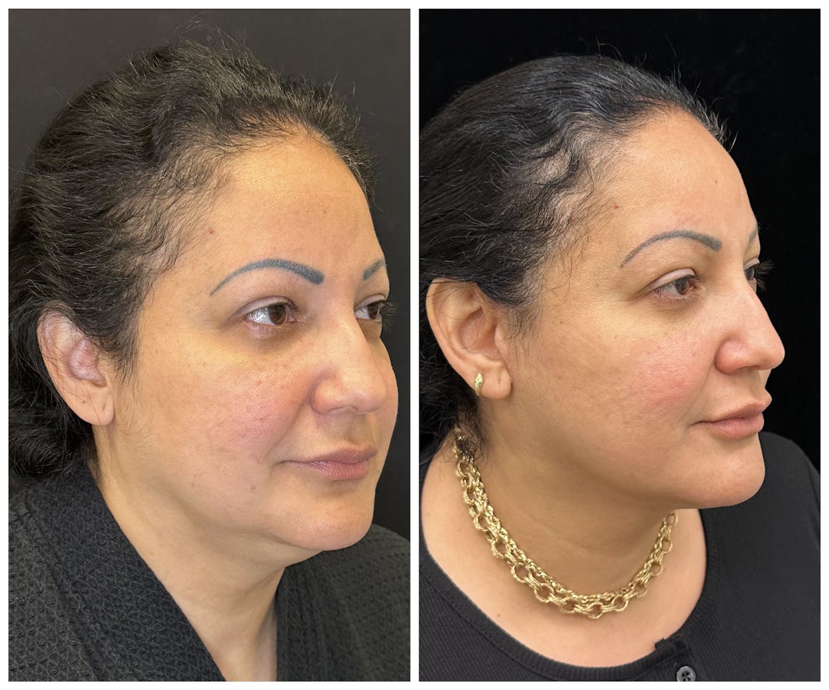 Deep Plane Facelift Before & After Gallery - Patient 101985 - Image 2