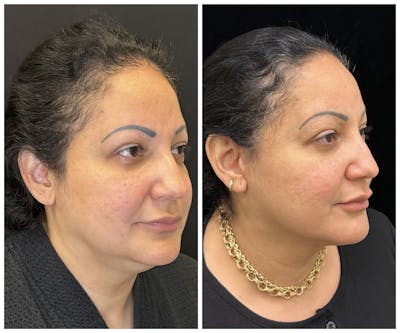 Deep Plane Facelift Before & After Gallery - Patient 101985 - Image 2