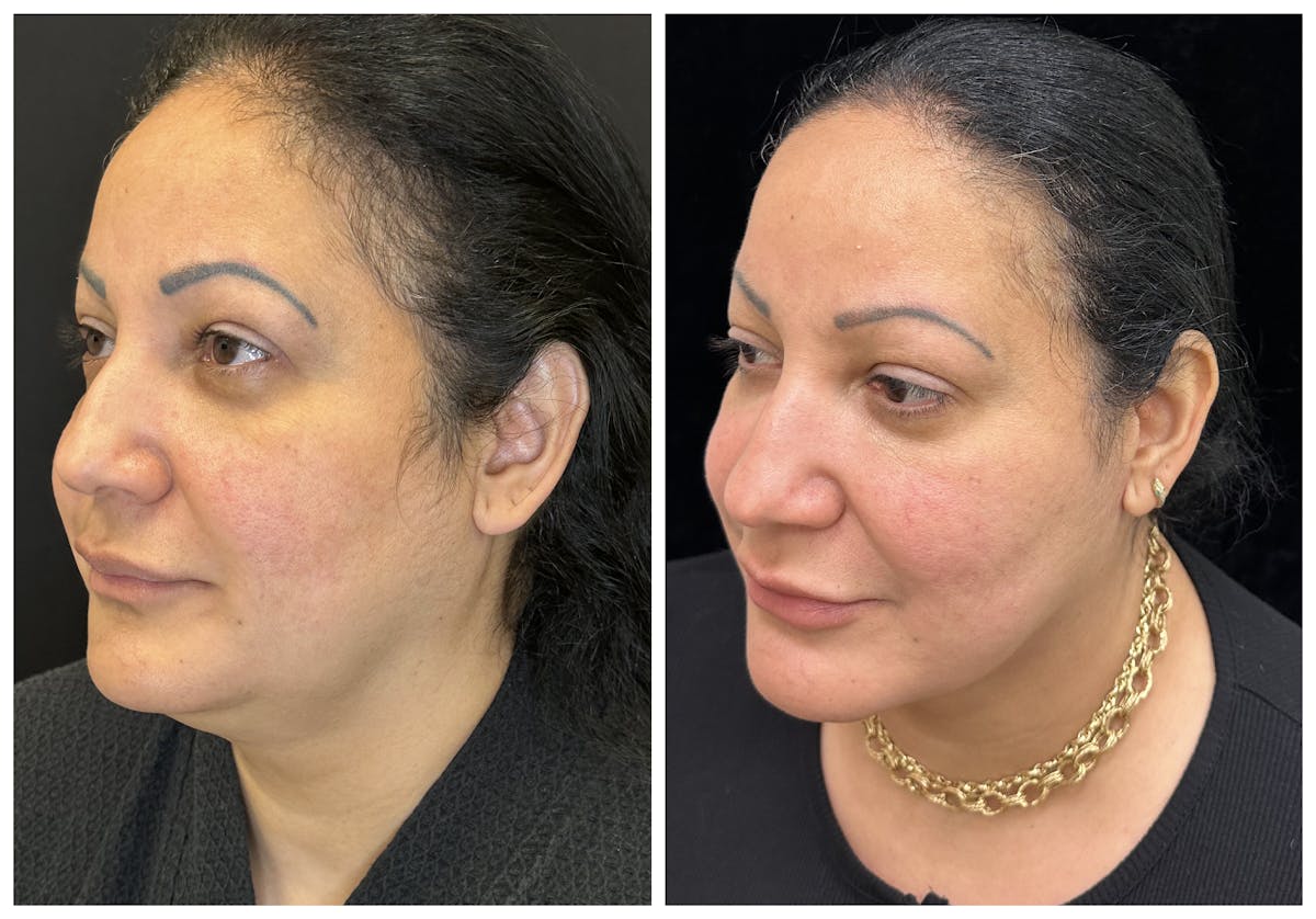 Deep Plane Facelift Before & After Gallery - Patient 101985 - Image 3