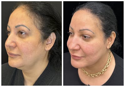 Deep Plane Facelift Before & After Gallery - Patient 101985 - Image 3