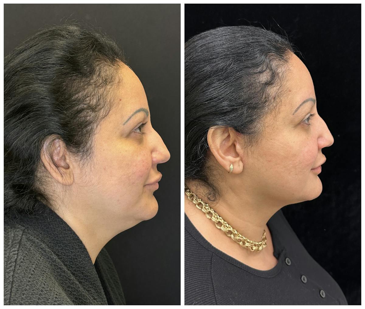 Deep Plane Facelift Before & After Gallery - Patient 101985 - Image 1