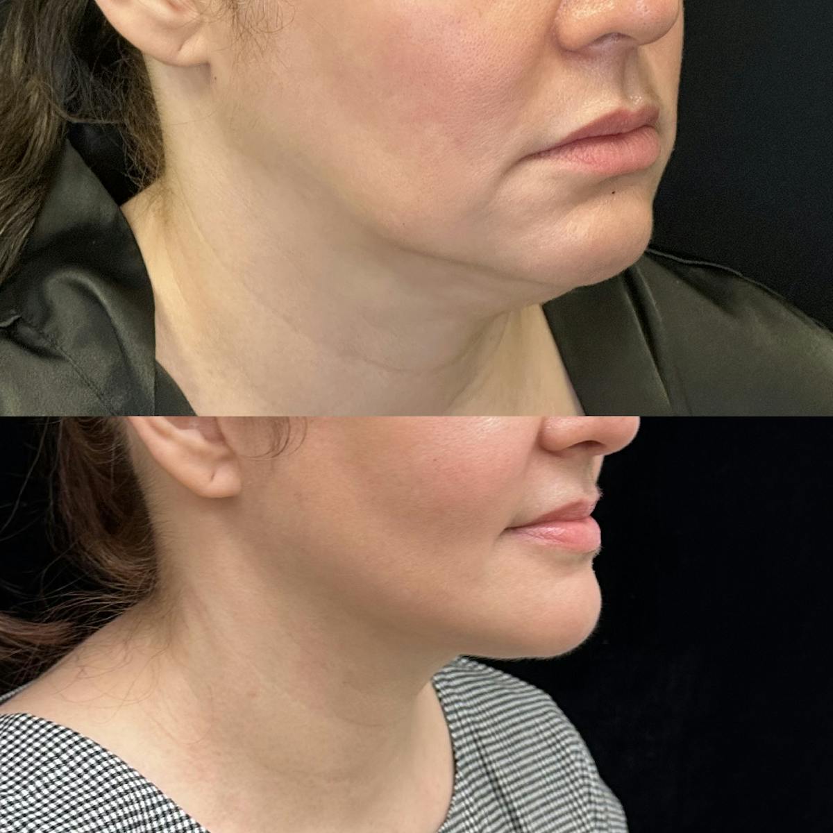 Deep Plane Facelift Before & After Gallery - Patient 380090 - Image 2
