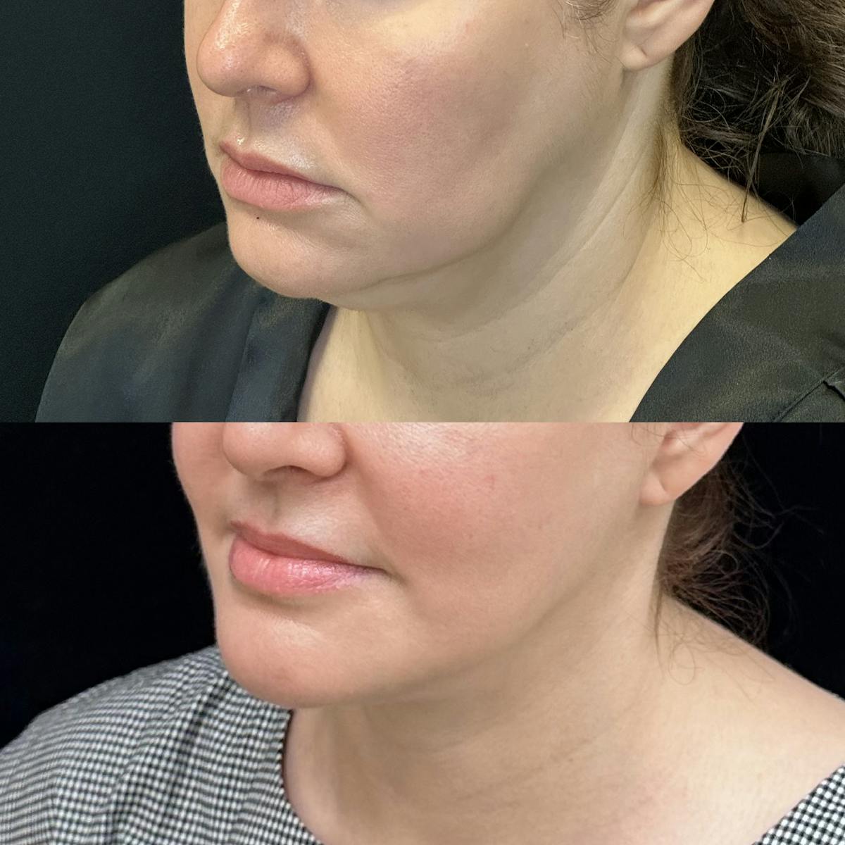 Deep Plane Facelift Before & After Gallery - Patient 380090 - Image 3