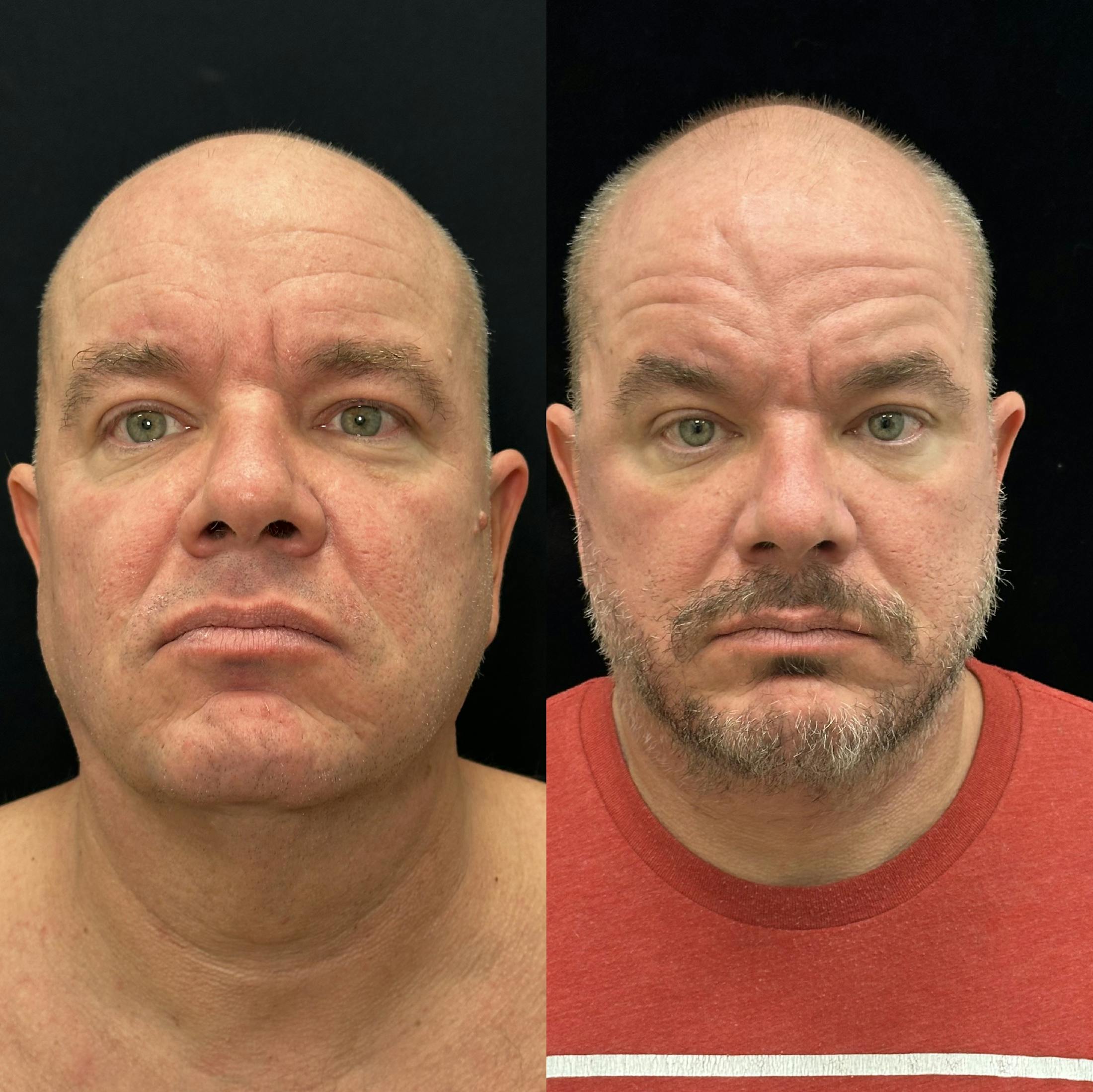 Deep Plane Facelift Before & After Gallery - Patient 366219 - Image 1
