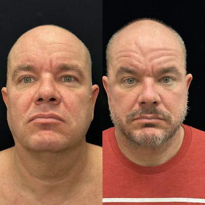 Male Facelift Before & After Gallery - Patient 270761 - Image 1
