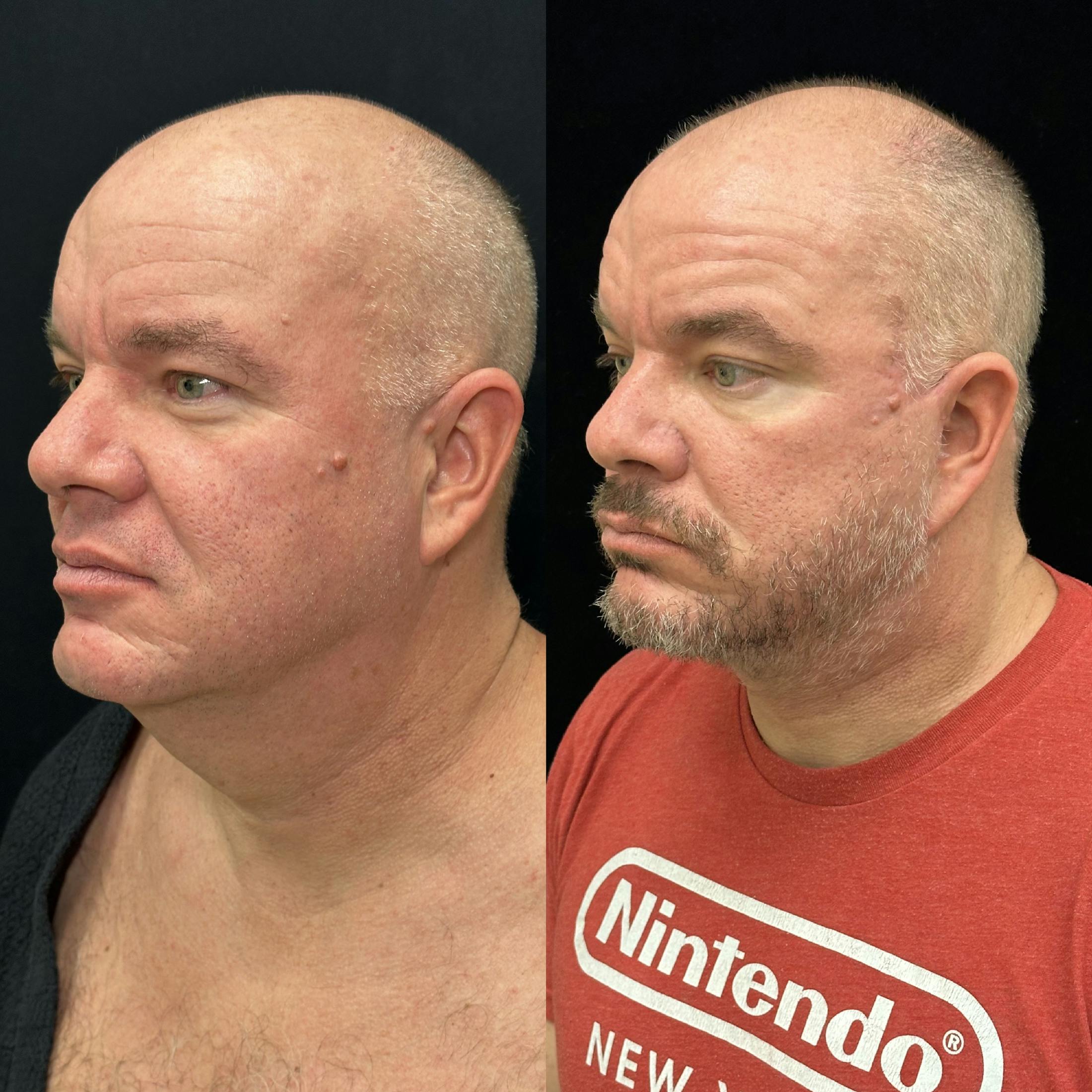 Deep Plane Facelift Before & After Gallery - Patient 366219 - Image 4