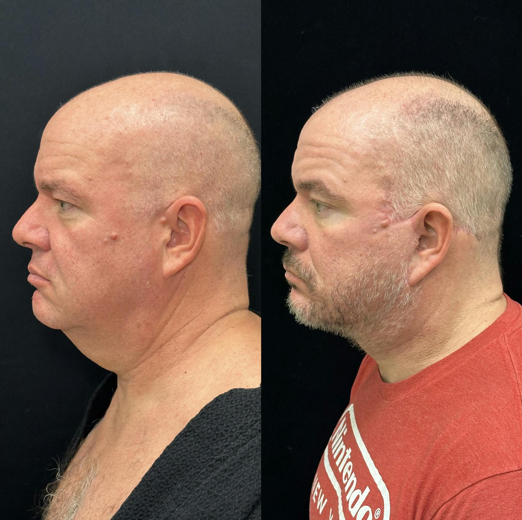 Deep Plane Facelift Before & After Gallery - Patient 366219 - Image 5