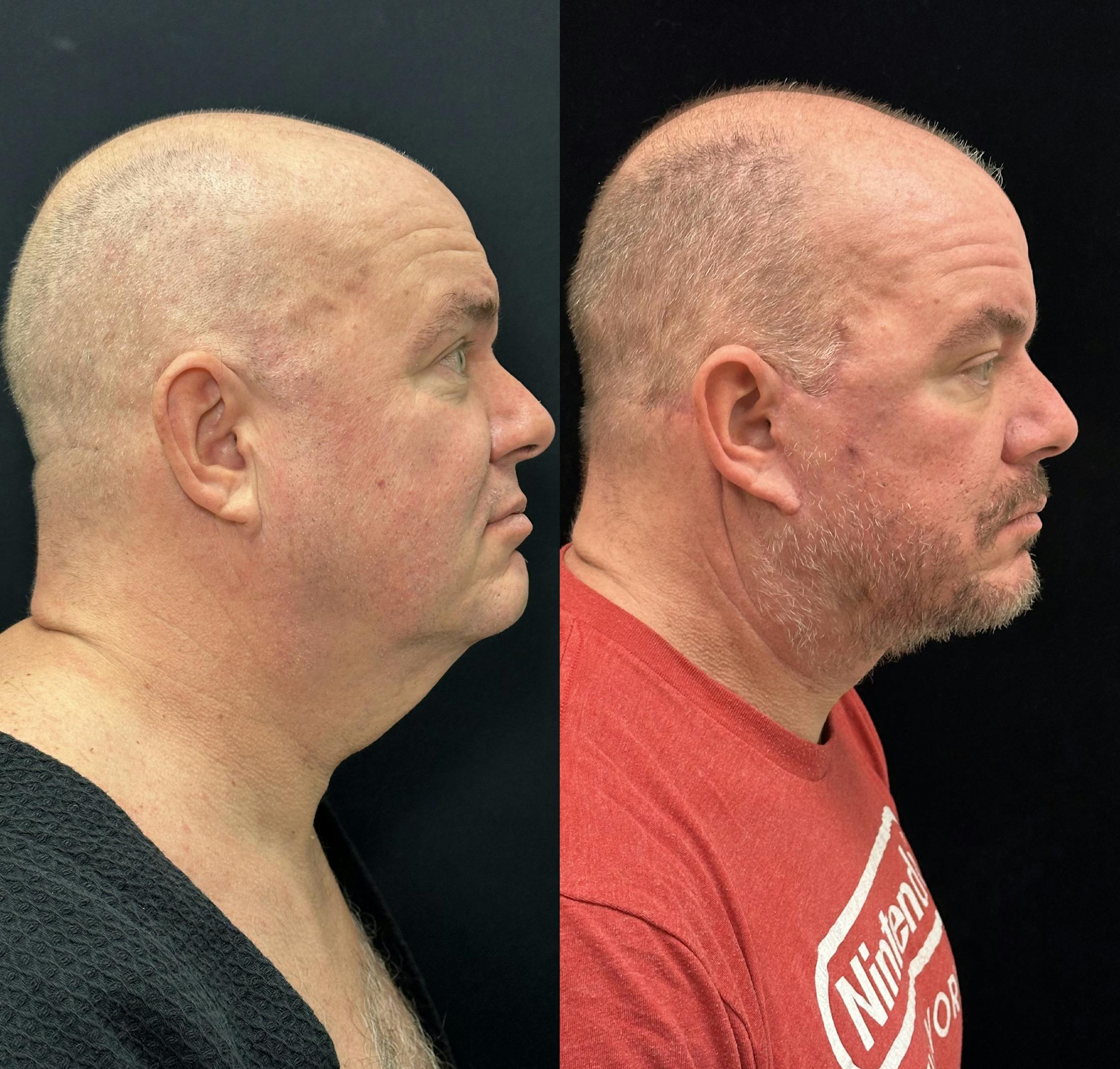 Deep Plane Facelift Before & After Gallery - Patient 366219 - Image 2
