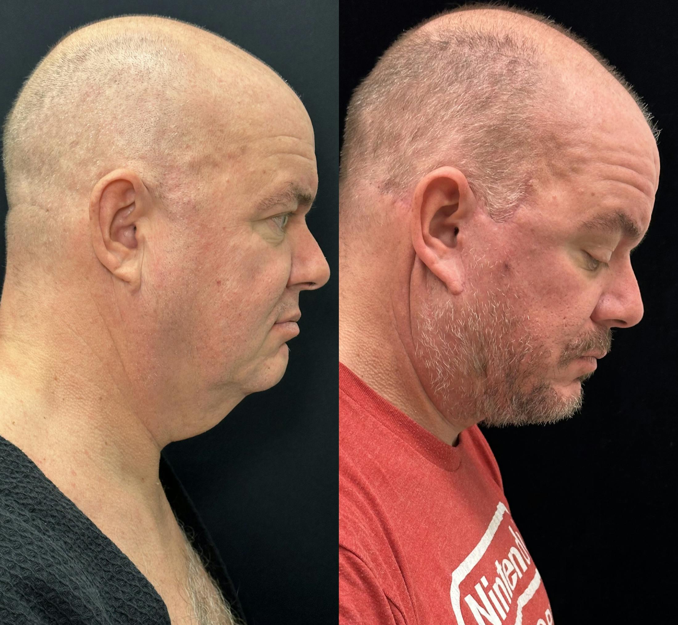 Deep Plane Facelift Before & After Gallery - Patient 366219 - Image 3