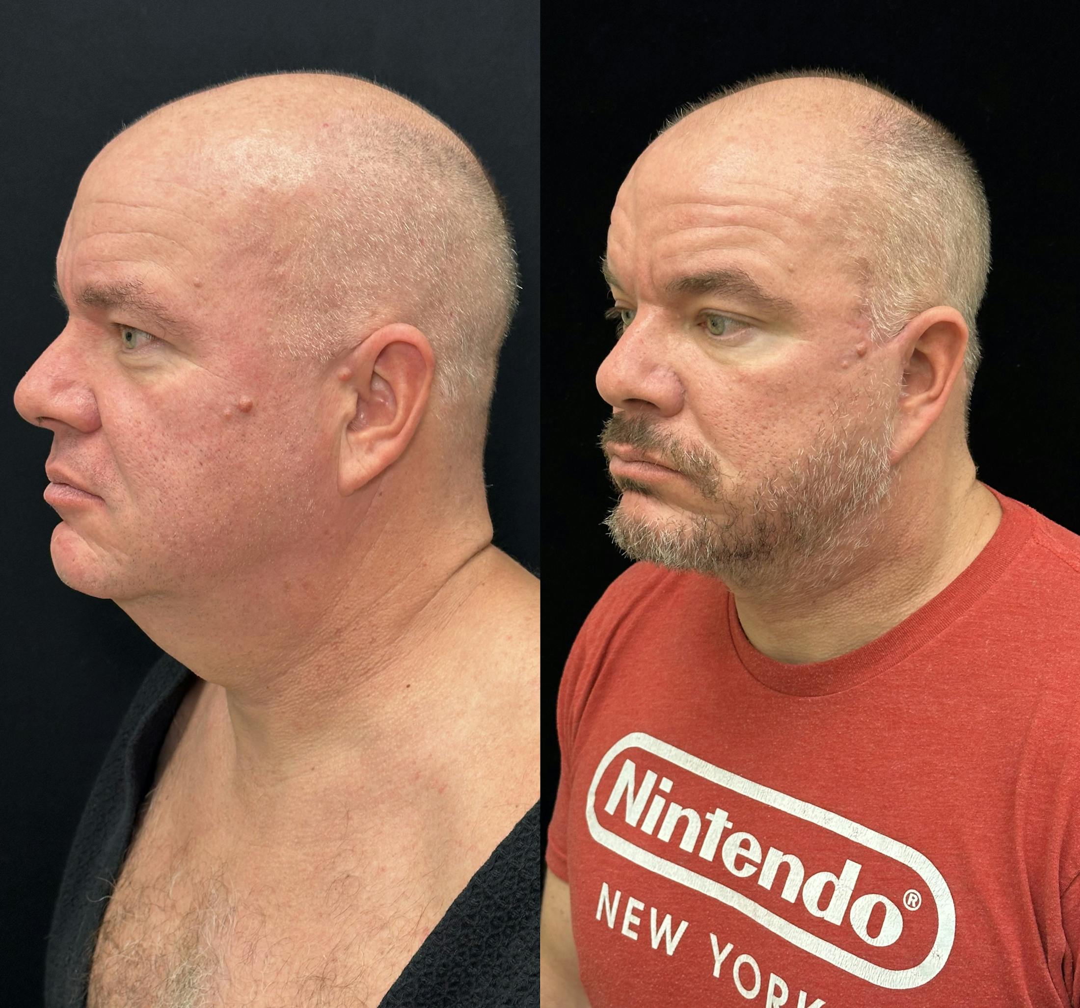 Deep Plane Facelift Before & After Gallery - Patient 366219 - Image 6