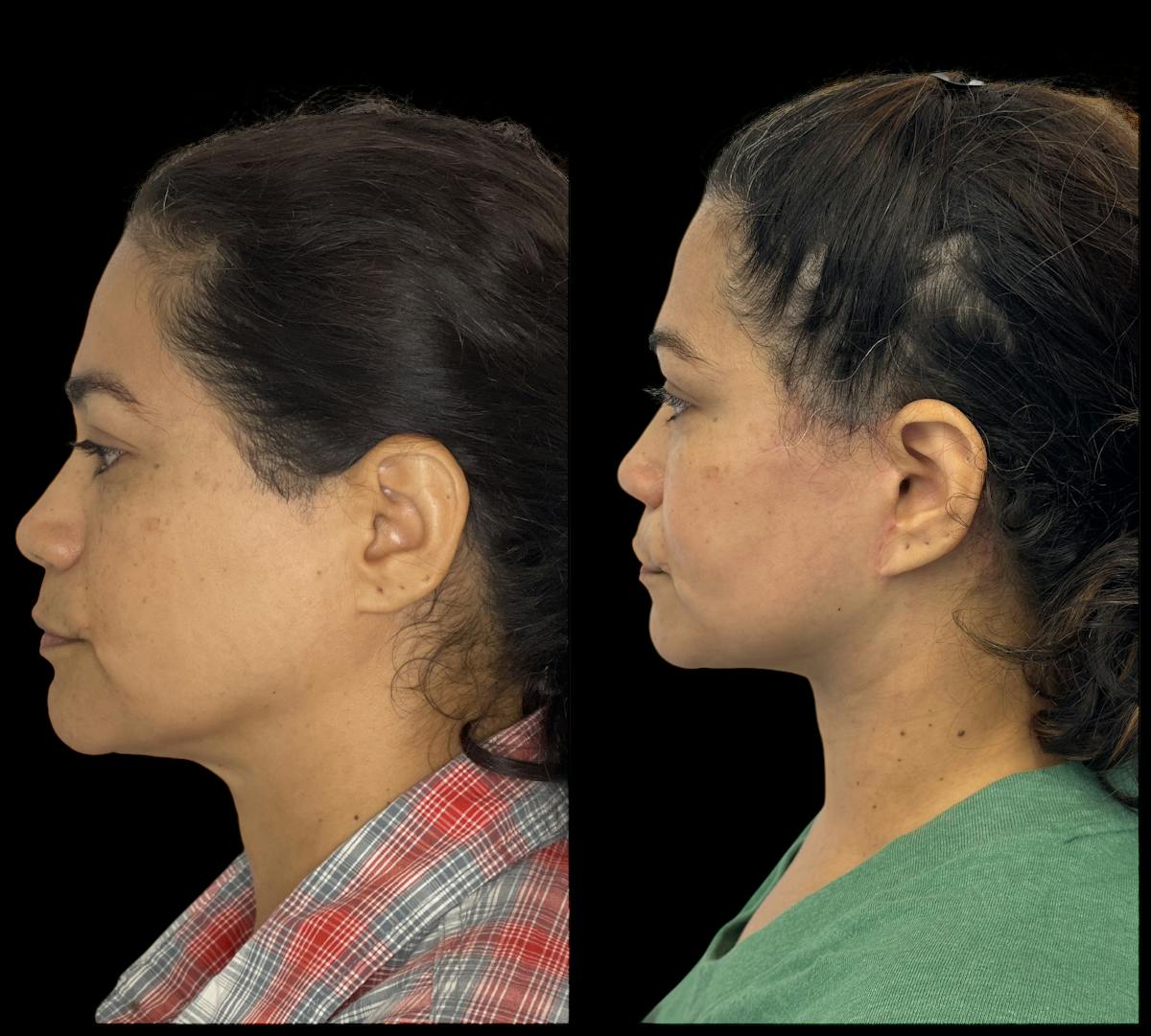 Deep Plane Facelift Before & After Gallery - Patient 418167 - Image 5