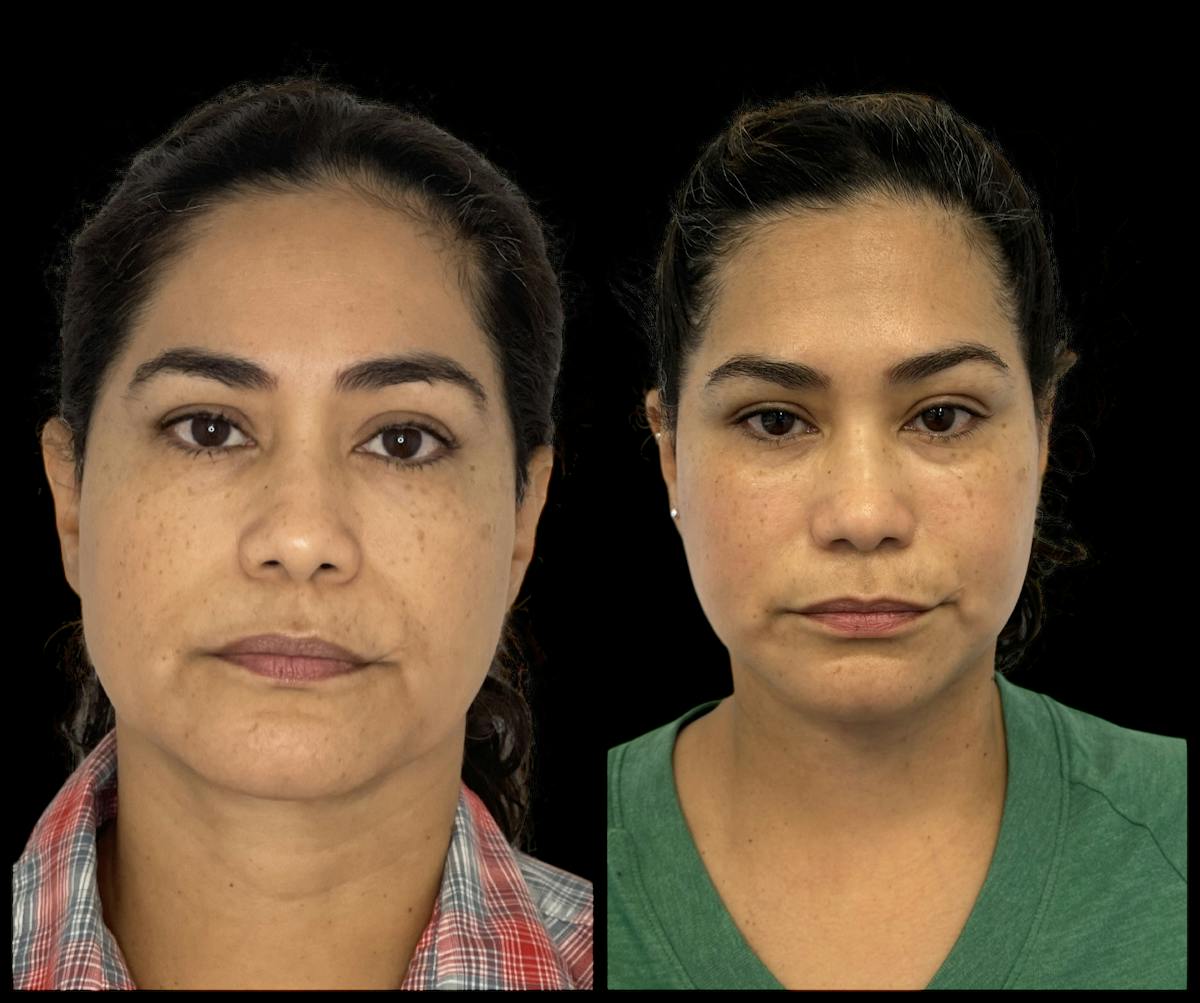 Deep Plane Facelift Before & After Gallery - Patient 418167 - Image 1
