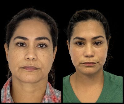 Deep Plane Facelift Before & After Gallery - Patient 418167 - Image 1