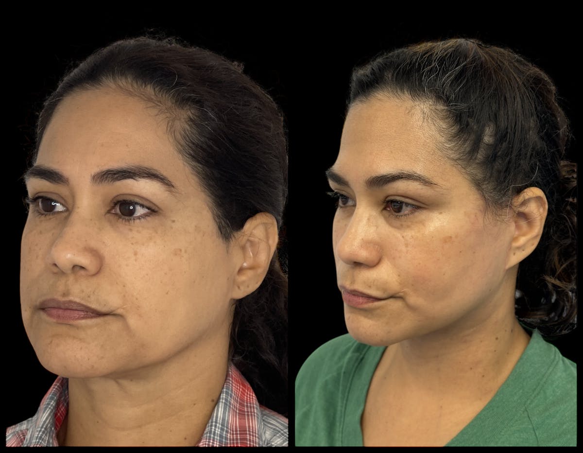 Deep Plane Facelift Before & After Gallery - Patient 418167 - Image 4