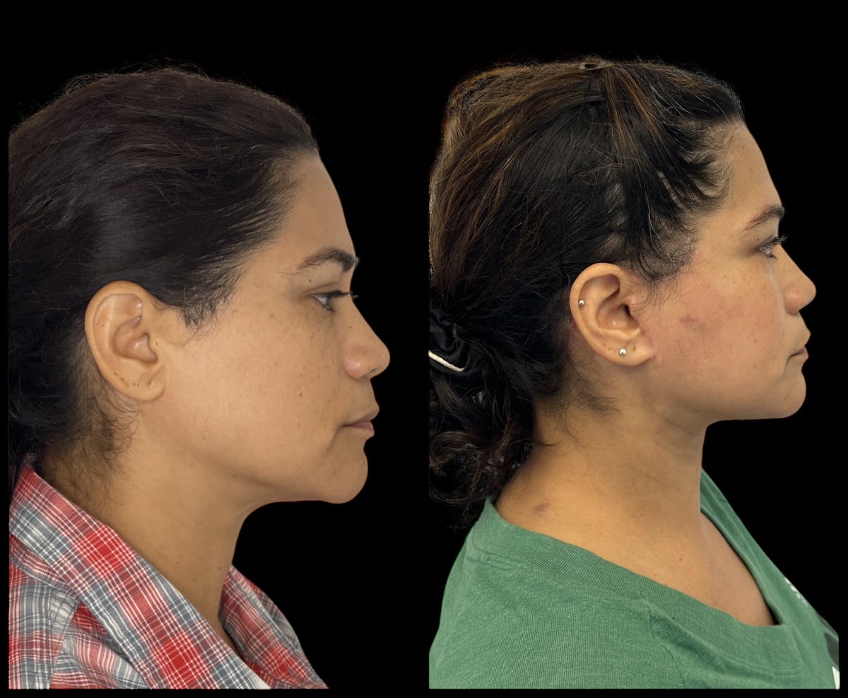 Deep Plane Facelift Before & After Gallery - Patient 418167 - Image 3